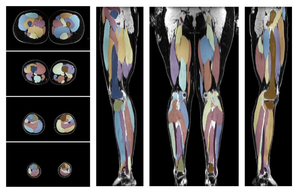 Overlay of automated muscle segmentation labels on dixon water image.